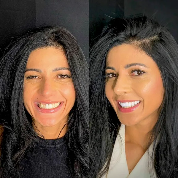 Paciente antes e depois das lentes de contato dental